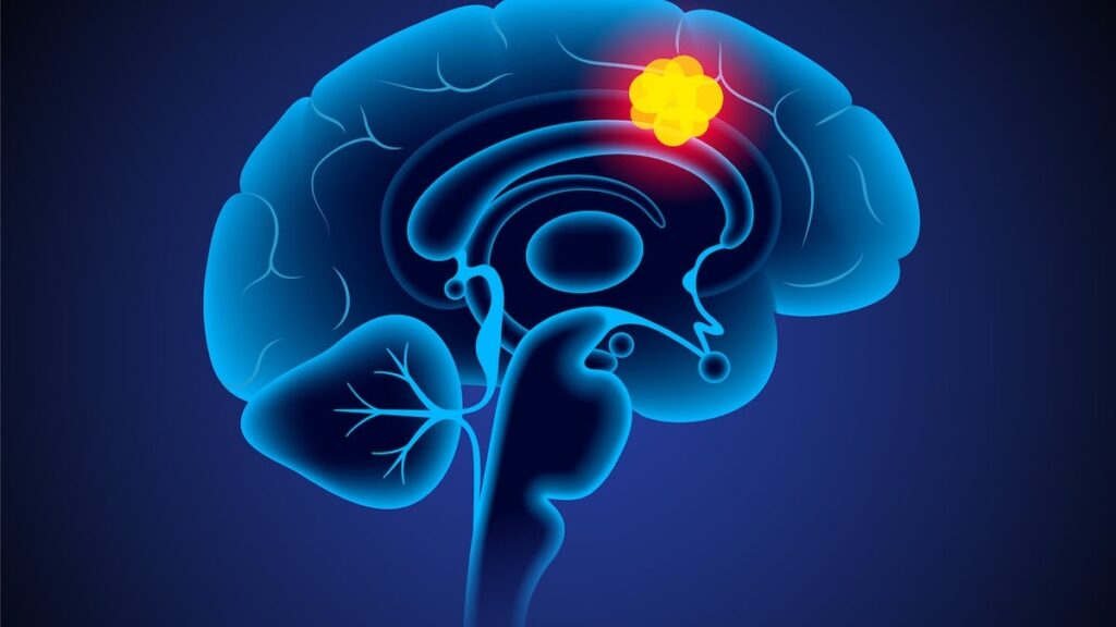 Patients with brain cancer received this medication against pain lived longer, according to studies