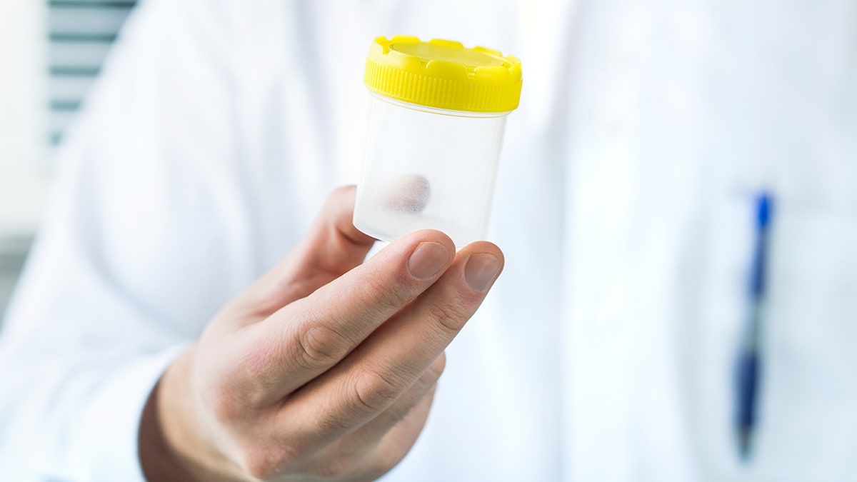 Sperm donor genetic mutation was related to cancer in 10 conceived children